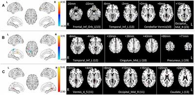 Local Functional MR Change Pattern and Its Association With Cognitive Function in Objectively-Defined Subtle Cognitive Decline